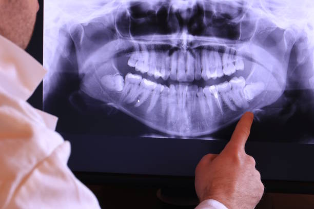Best Emergency Wisdom Tooth Extraction in Herricks, NY